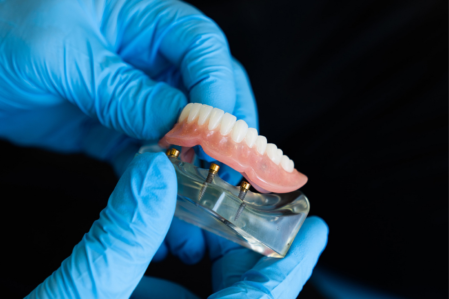 Hands in blue gloves holding a set of dentures attached to a clear implant model.