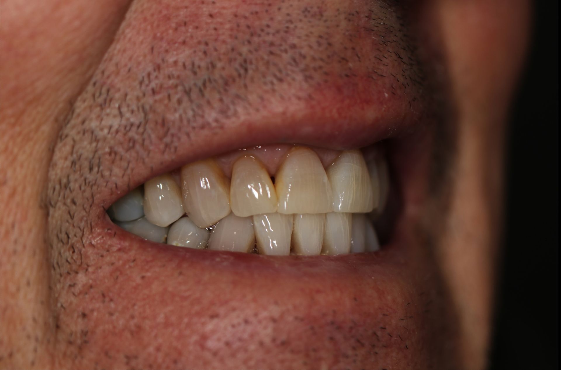 A close up of a woman 's smile with white teeth.