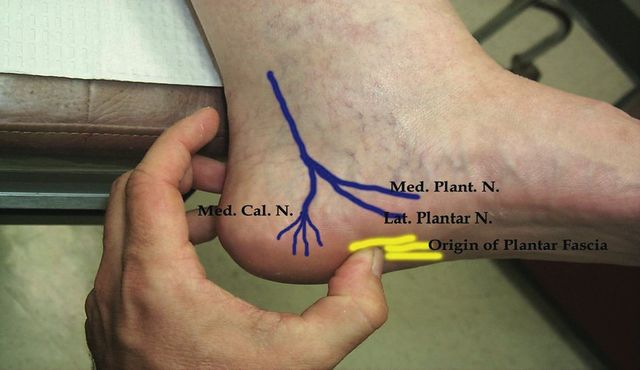 Heel pain on on sale inside of heel