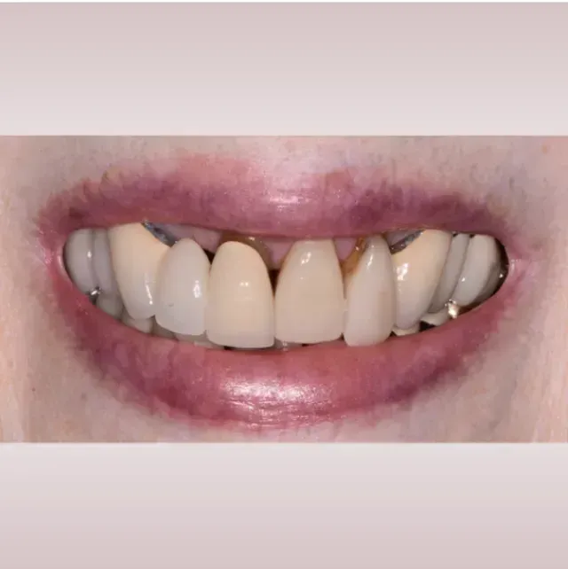 Close-up of a person's mouth with visible teeth. Some teeth are discolored or damaged, others appear to be capped. Lips are lined and shaded.