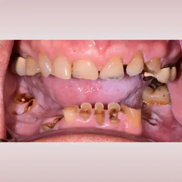Mouth with severely decayed teeth and missing teeth; yellowed, damaged appearance.