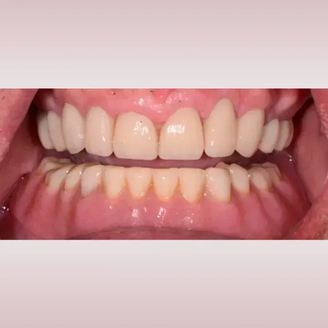 Close-up view of teeth and gums. The teeth are white, in perfect alignment. The gums are pink and healthy-looking.