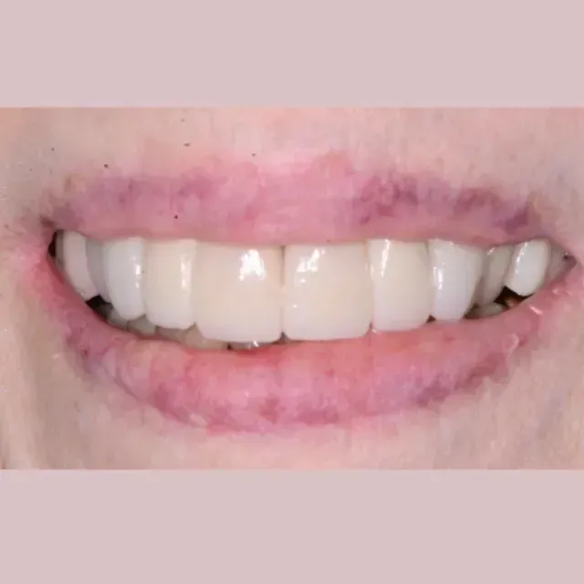 Close-up of a person's smiling mouth showing a bright, even set of teeth, framed by pink lips.