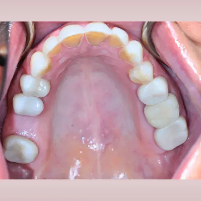 Close-up view of the upper teeth showing dental work, including crowns and bridges.