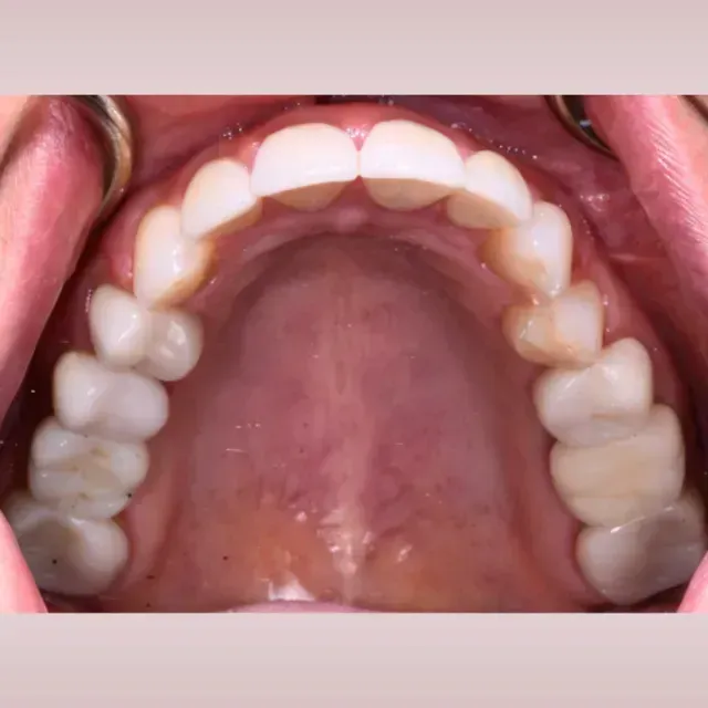 Close-up of upper teeth; shows an arched row of white teeth with slight discoloration on some.