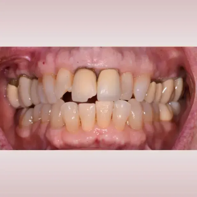 Close-up of teeth, with a chipped front tooth and yellowing color.