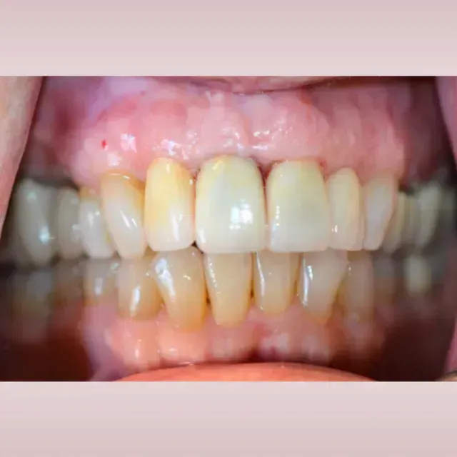 Close-up of teeth, some yellowish, in an open mouth. The gums are visible and pink.
