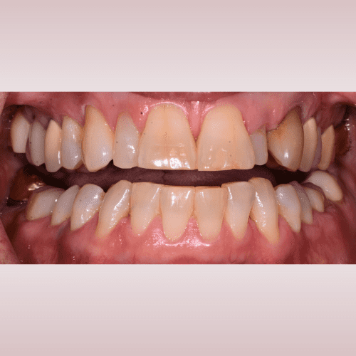 Close-up of teeth, yellowed with some staining, in a mouth.