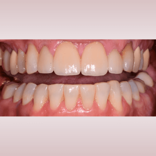 Close-up of a person's teeth. Upper and lower rows of teeth are visible; teeth are a light color.