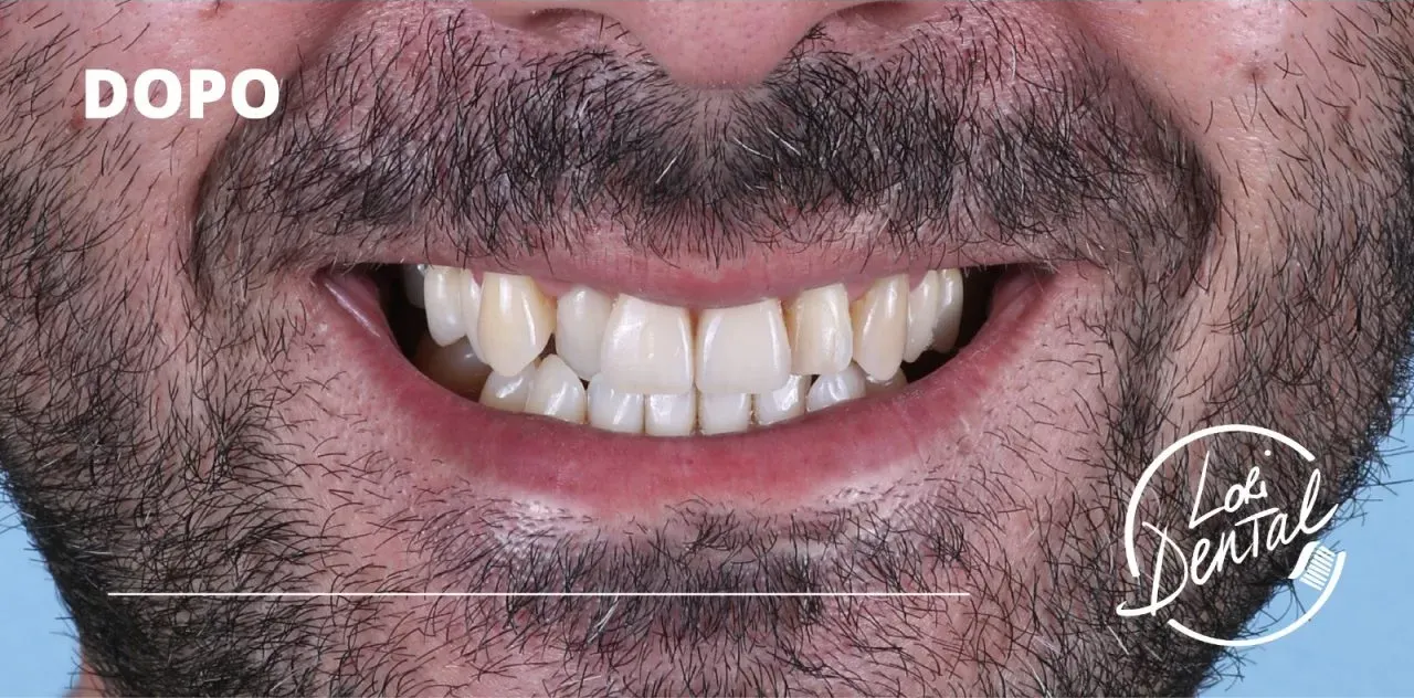 denti dopo un trattamento odontoiatrico, con la scritta
