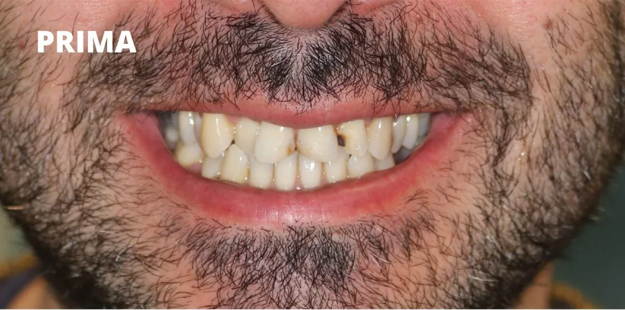 denti leggermente affollati e disallineati, con alcune discromie. Testo 