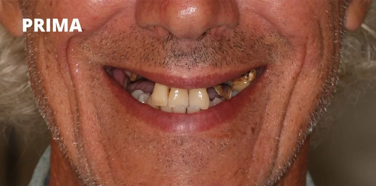 Primo piano della bocca di una persona che mostra denti mancanti, scoloriti e consumati,