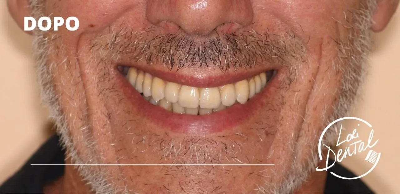 Una bocca sorridente con una dentatura riparata, etichettata