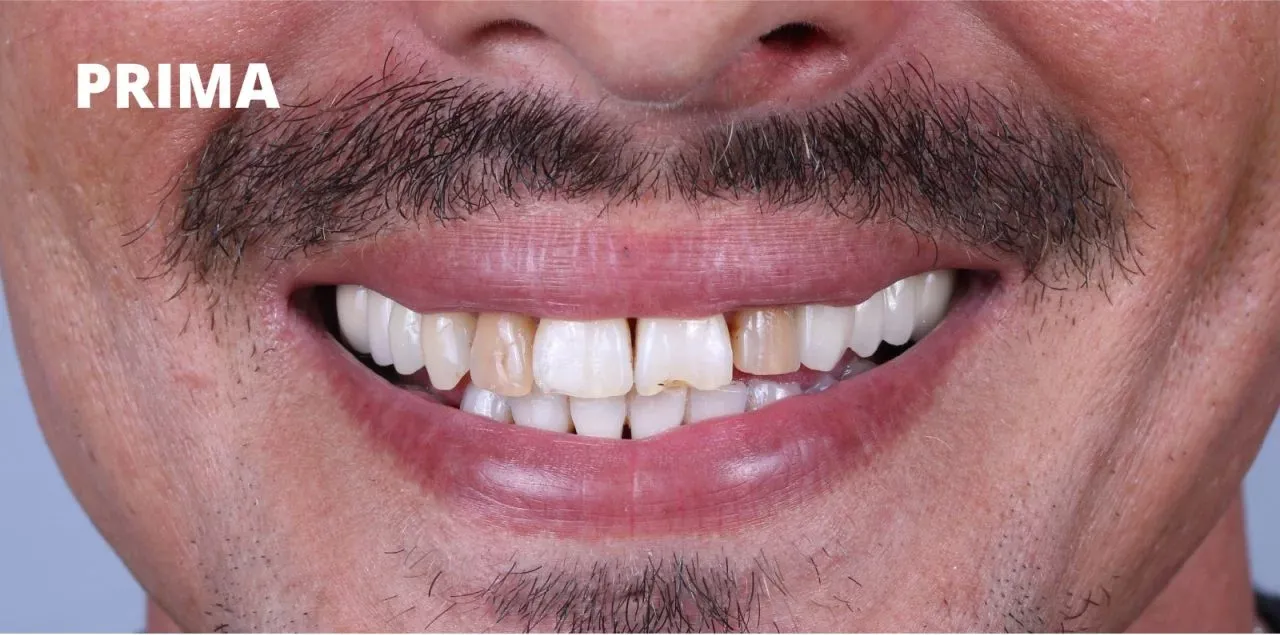 denti leggermente scoloriti e un piccolo spazio tra gli incisivi centrali.