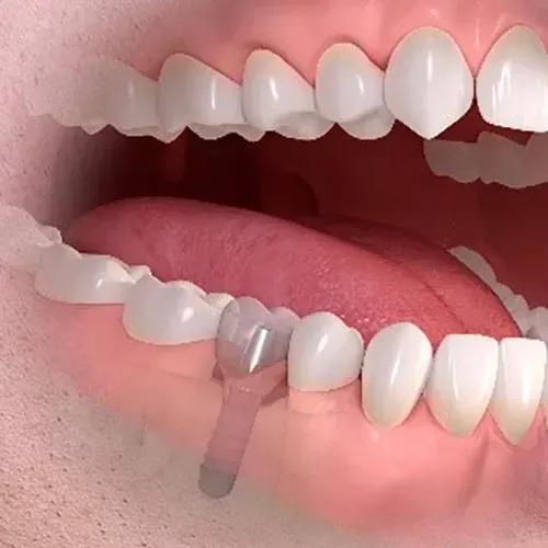 Illustrazione digitale che mostra un impianto dentale in sostituzione di un dente mancante nella gengiva inferiore.