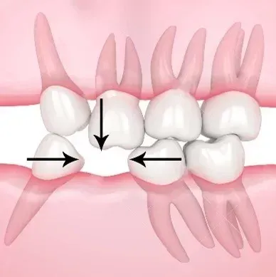 Illustrazione odontoiatrica implantologia