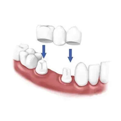 Un ponte dentale viene posizionato su due denti preparati per colmare uno spazio vuoto nella linea gengivale.
