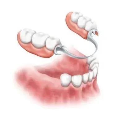 Un ponte dentale parziale con due sezioni di denti protesici tenute insieme. implantologia