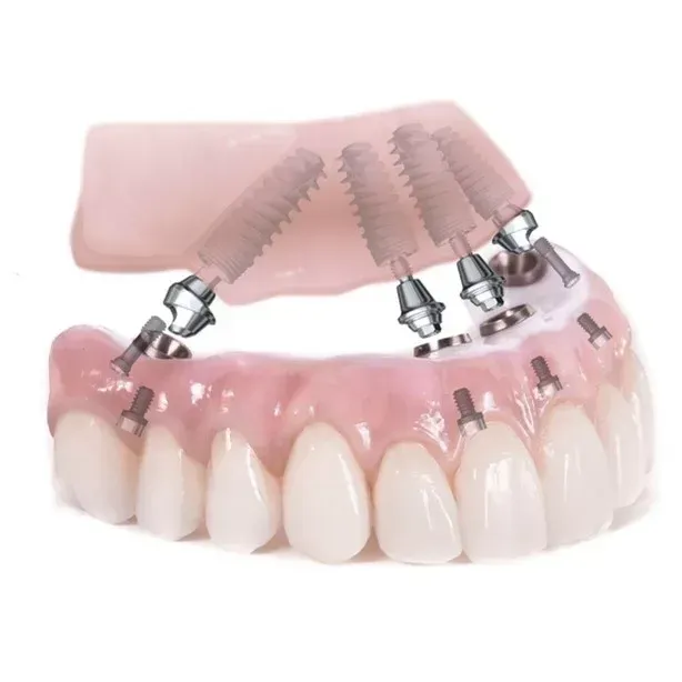 Un ponte su impianti dentali che mostra i denti protesici fissati a monconi metallici e viti ancorate all'osso.