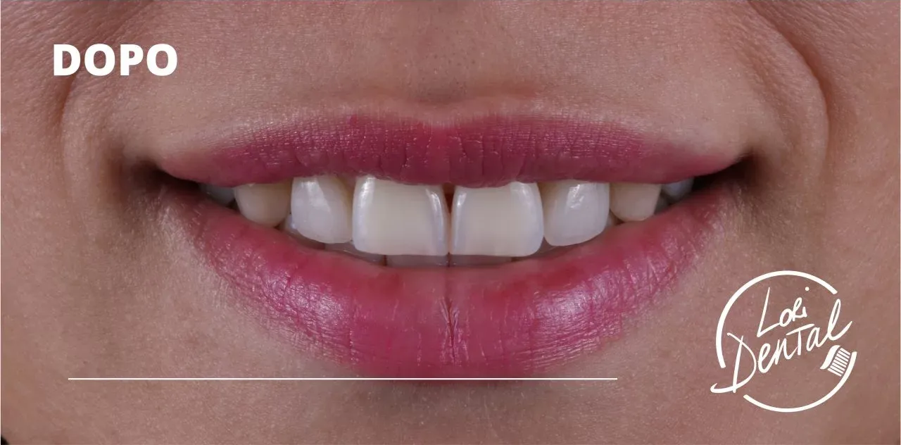 denti dritti e bianchi dopo un intervento di odontoiatria estetica, etichettata