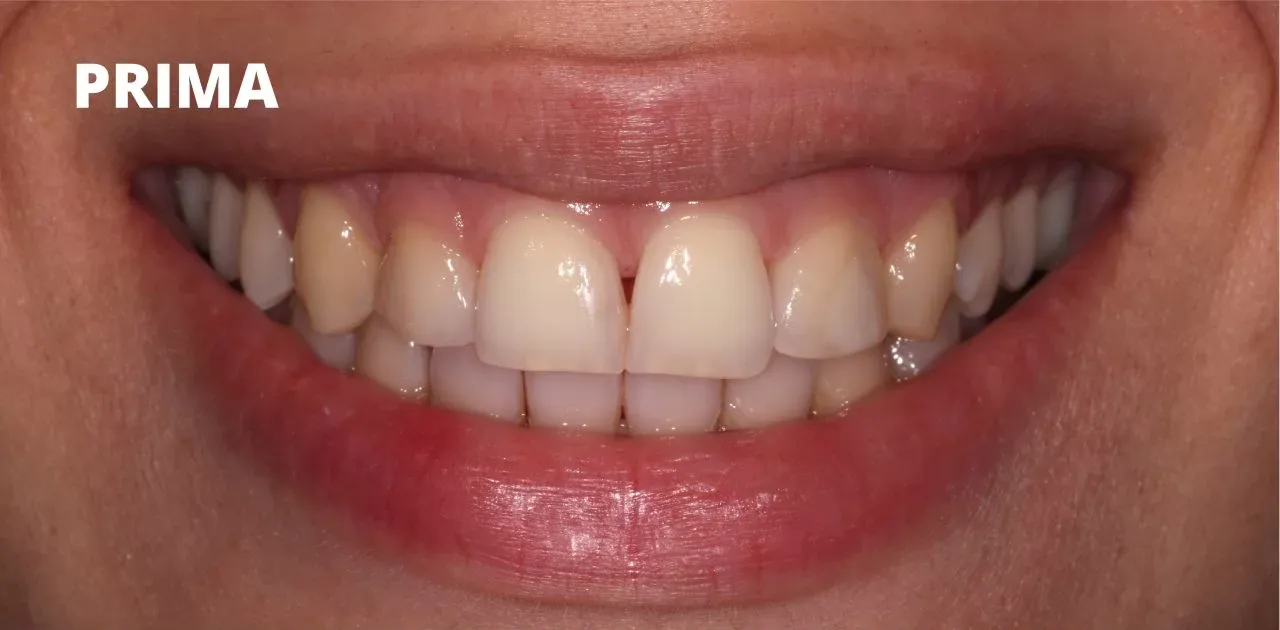 uno spazio naturale tra i due incisivi superiori, etichettato con la parola 