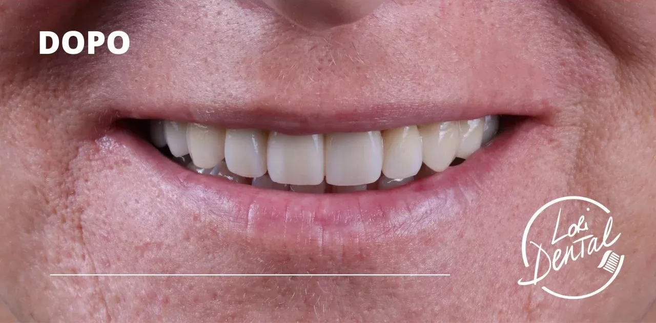 dopo trattamento odontoiatrico, che mostra una fila di denti uniformi, bianchi e restaurati.