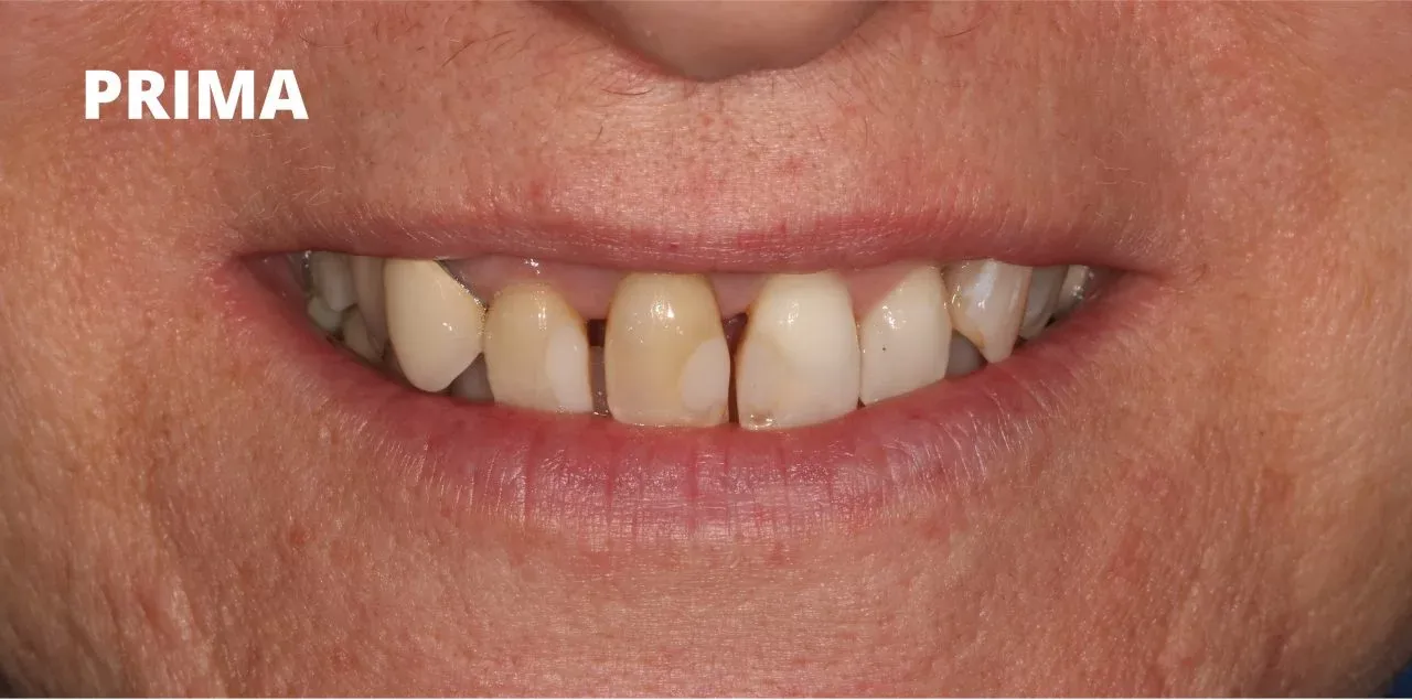 denti macchiati e disallineati prima di un trattamento odontoiatrico estetico.