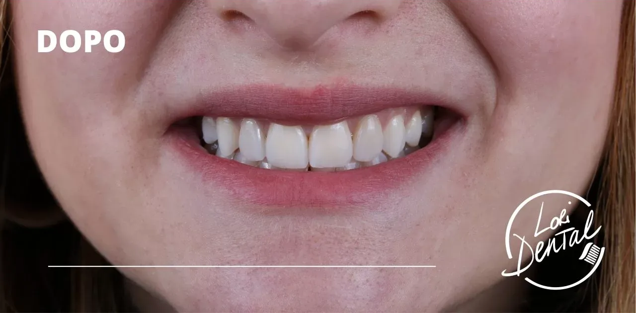 denti dritti e bianchi. dopo trattamento