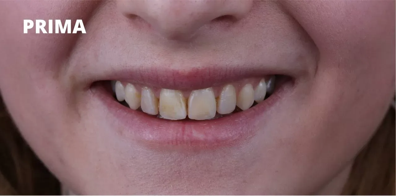 Primo piano della bocca di una persona sorridente, che mostra denti leggermente ingialliti e dalla forma irregolare.