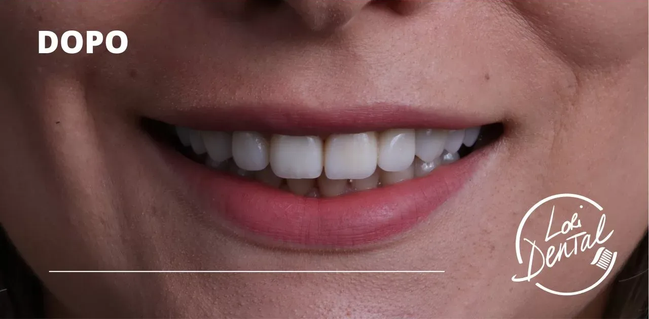 Primo piano di una persona sorridente, che mostra denti dritti e bianchissimi. Nell'angolo si legge