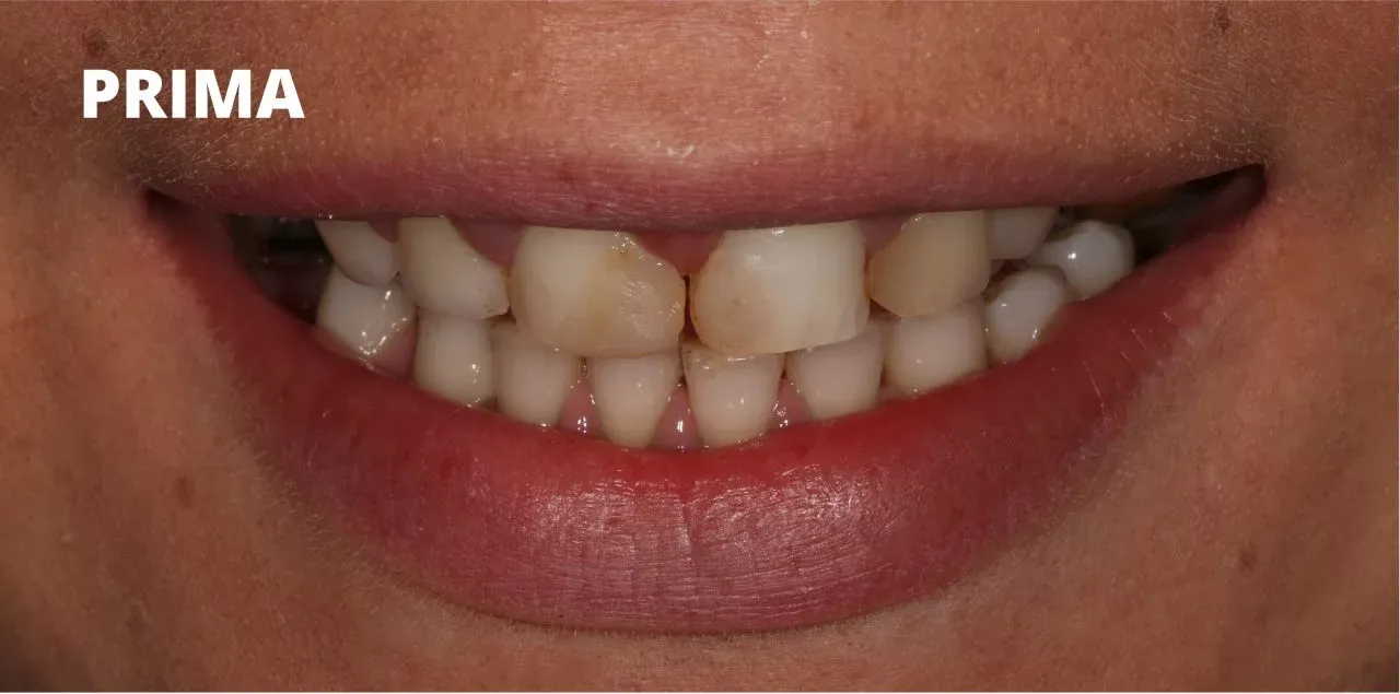 Un primo piano dei denti che mostra disallineamento, scolorimento e uno spazio tra i due incisivi frontali