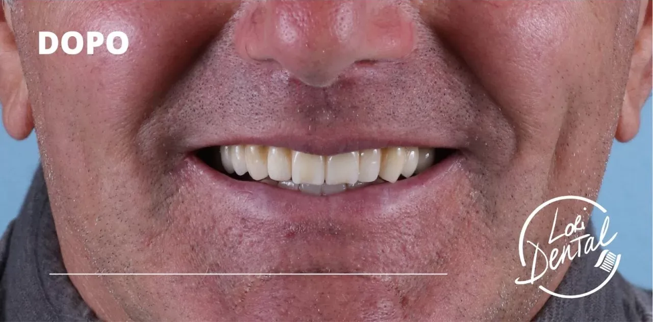 Primo piano della bocca di una persona dopo un trattamento odontoiatrico