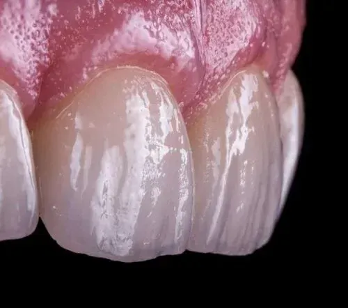 Implantologia dentale - Procedura di impianto