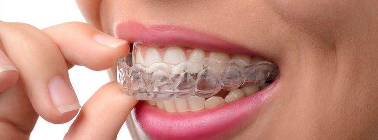 Implantologia dentale - Procedura di impianto