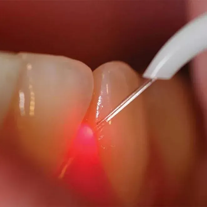 Implantologia dentale - Procedura di impianto