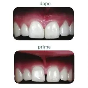 Implantologia dentale - Procedura di impianto