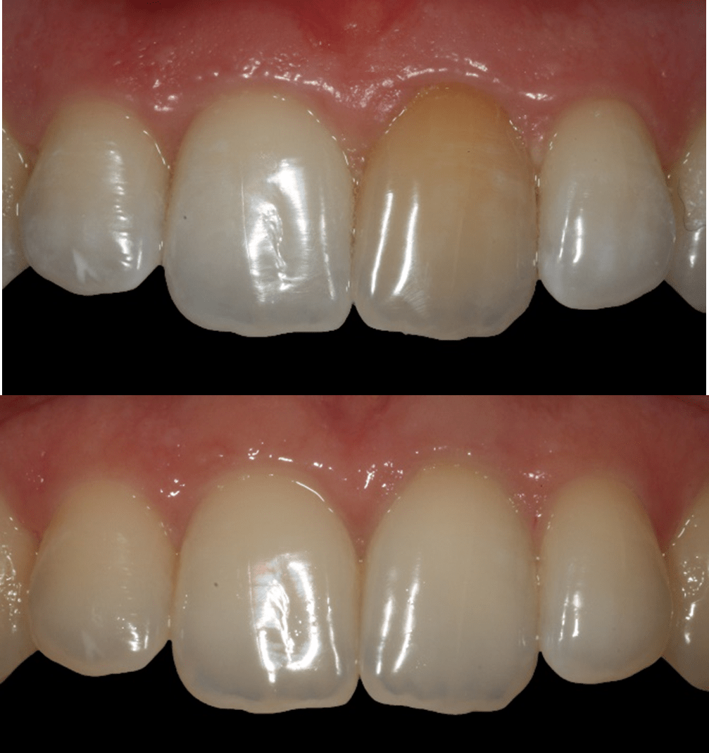 sbiancamento dentale