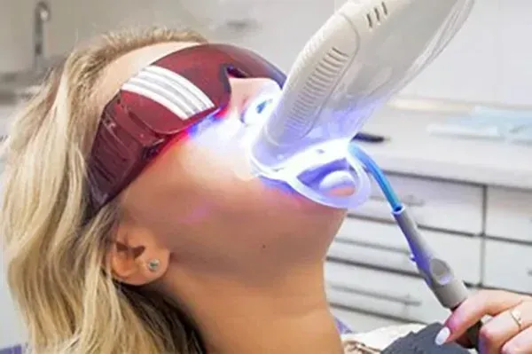 sbiancamento dentale