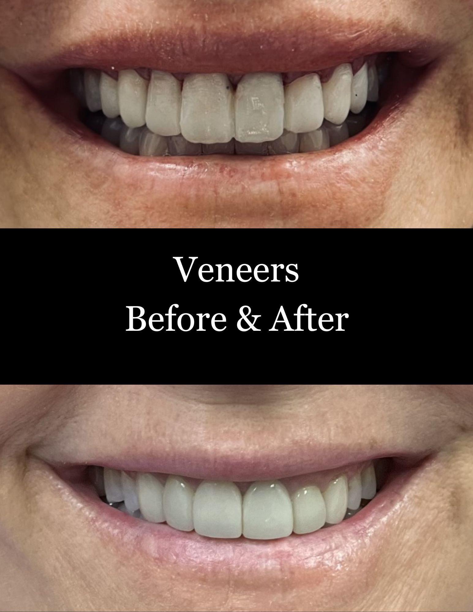 Before-and-after smile showing veneers: discolored teeth above, whiter even teeth below.