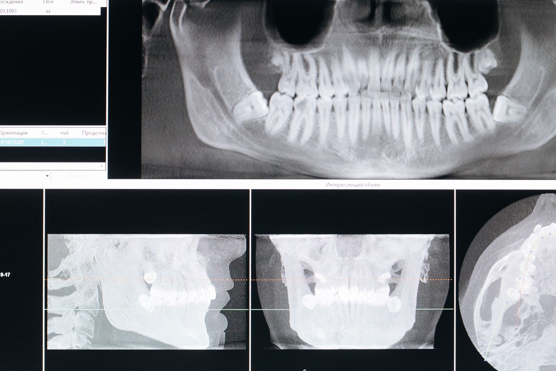 Dental X-ray collage showing panoramic and side-view scans of teeth and jaw.