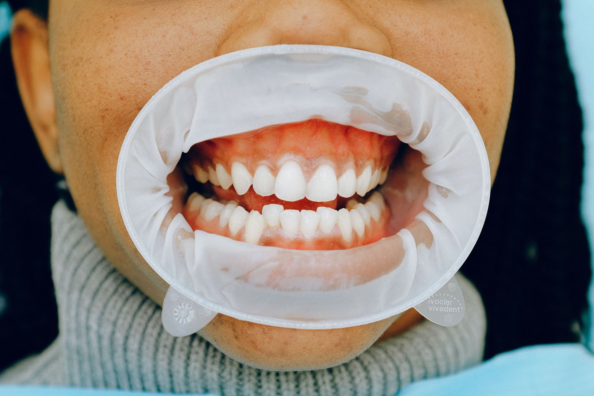 Close-up of a mouth with a dental cheek retractor showing teeth and gums.