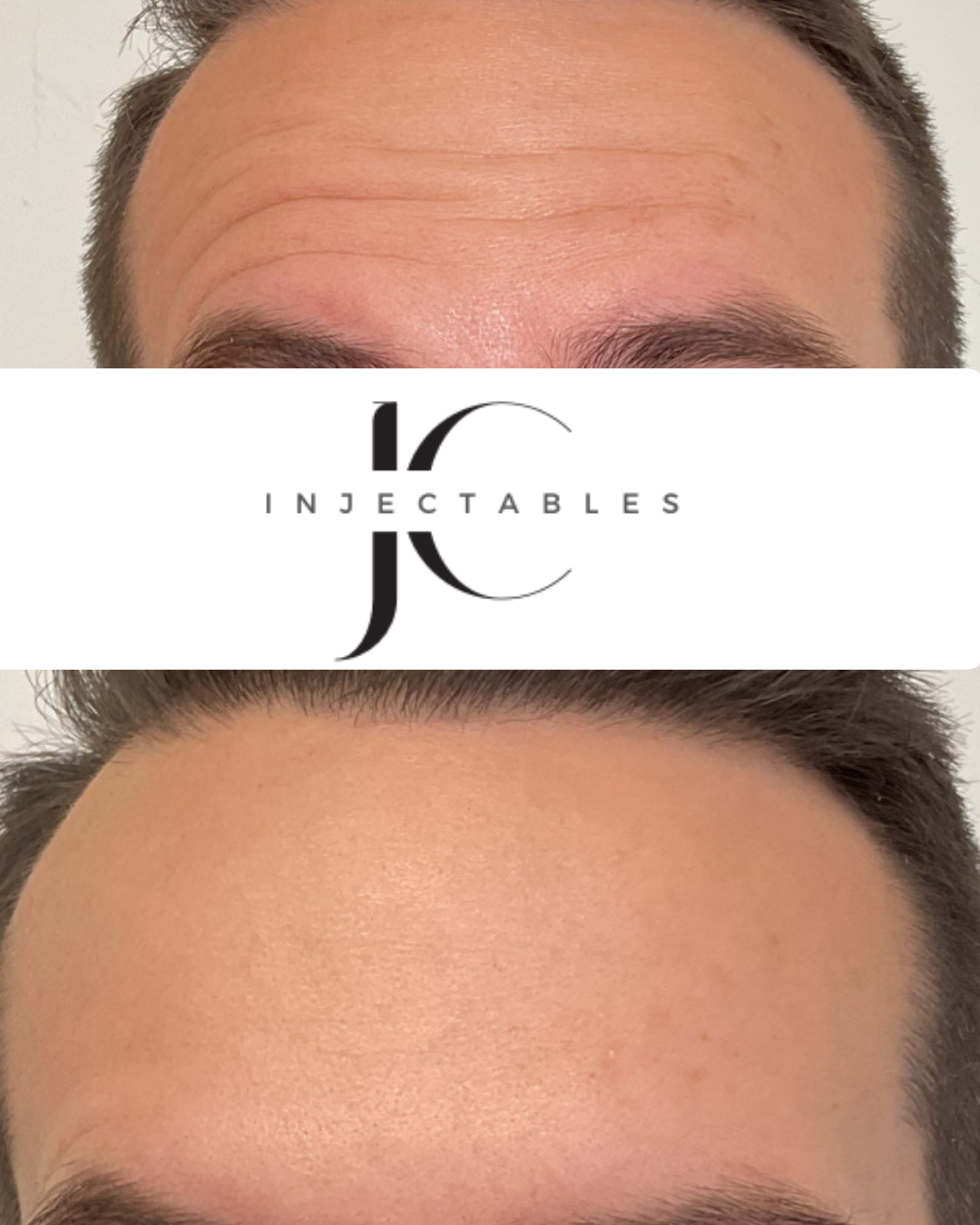JC Injectables Before and After Image