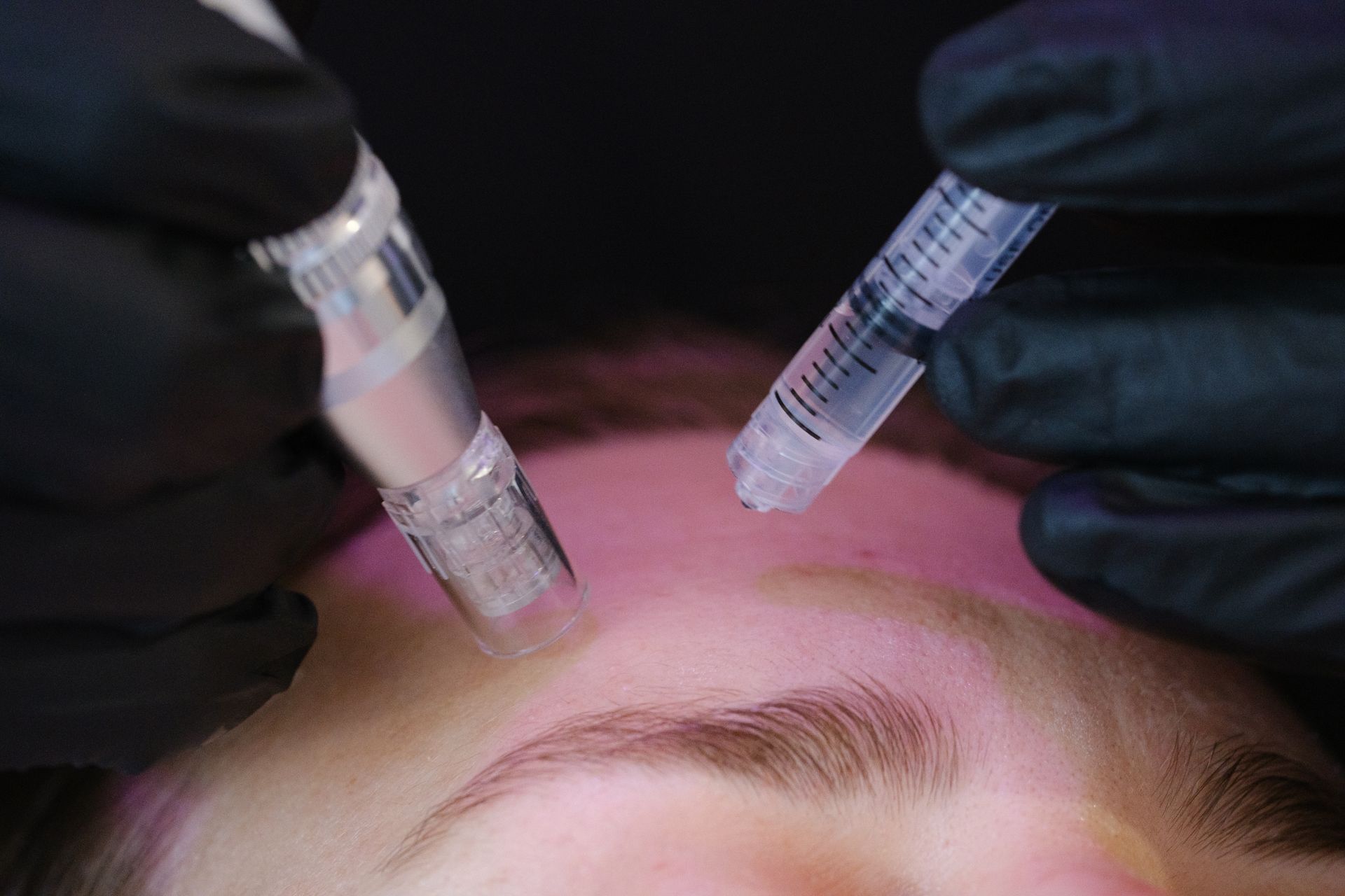 A woman is getting a micro needling treatment