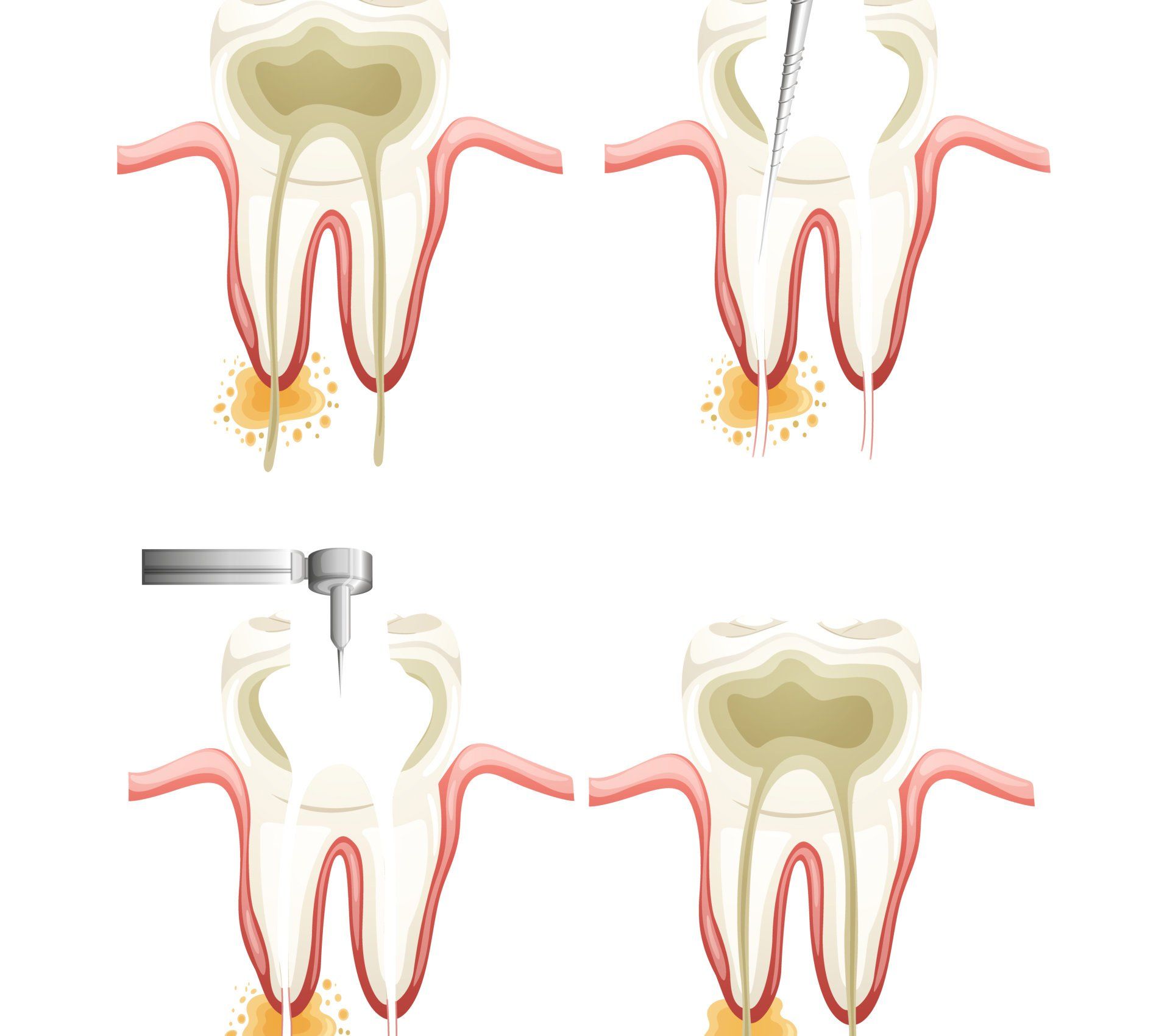 Ellicott City Dentistry - Root Canal