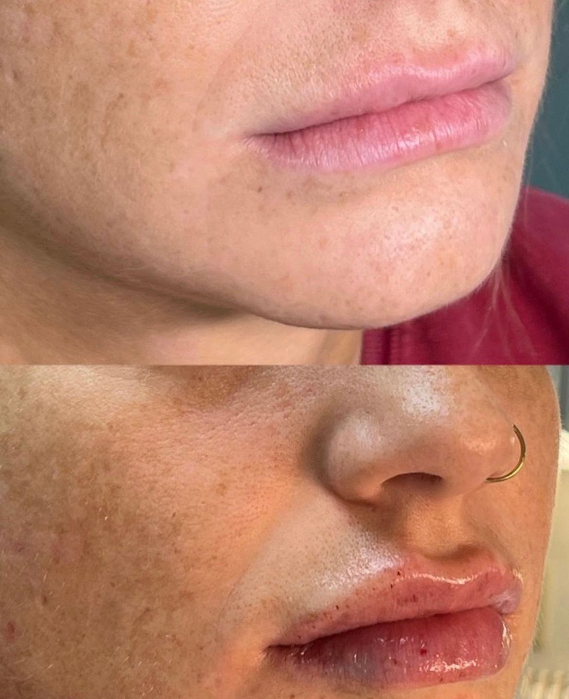 Before and After Injections at Conway Med Spa