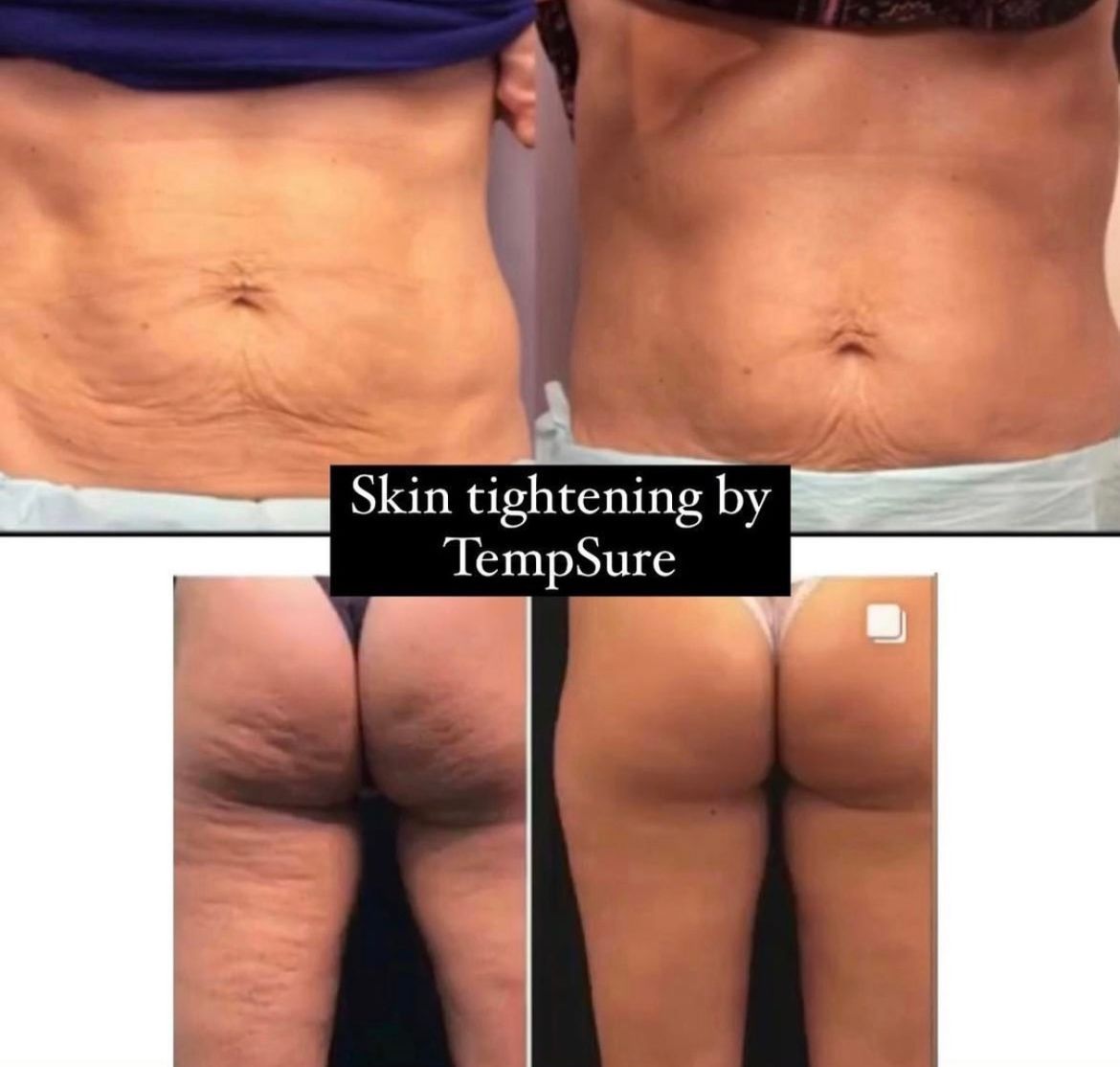 Skin Tightening at Conway Med Spa