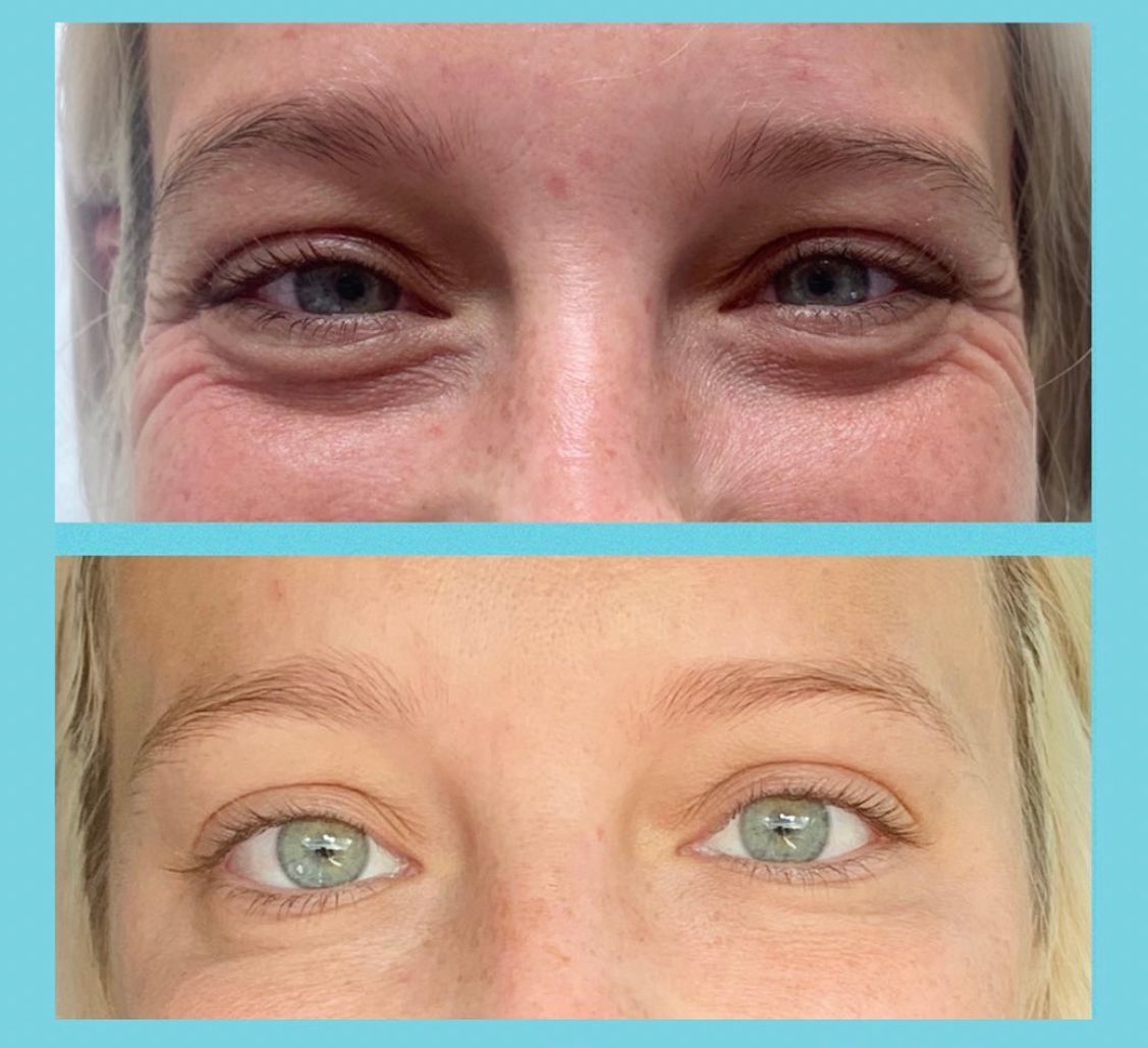 Before and After Injections at Conway Med Spa