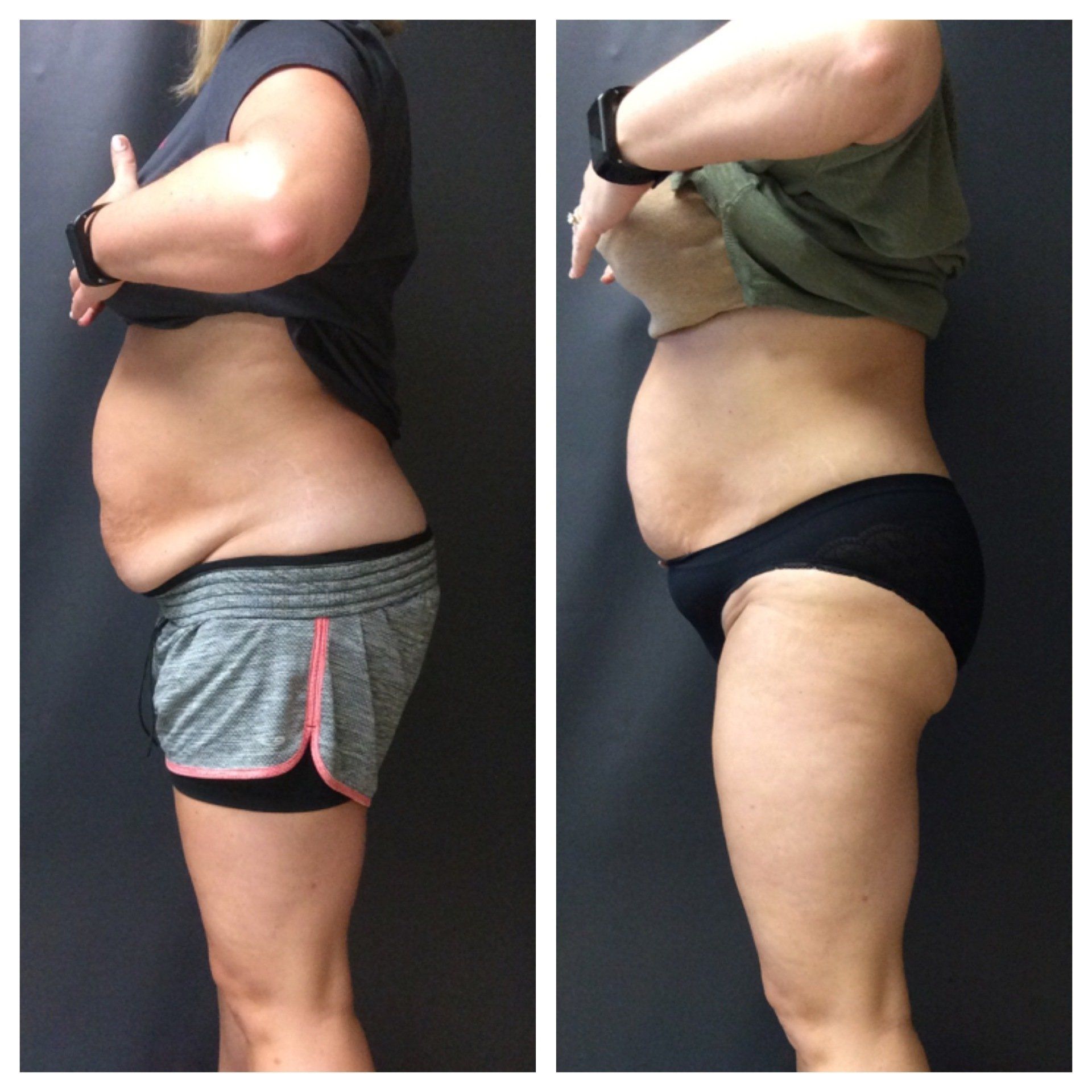 non-surgical fat reduction