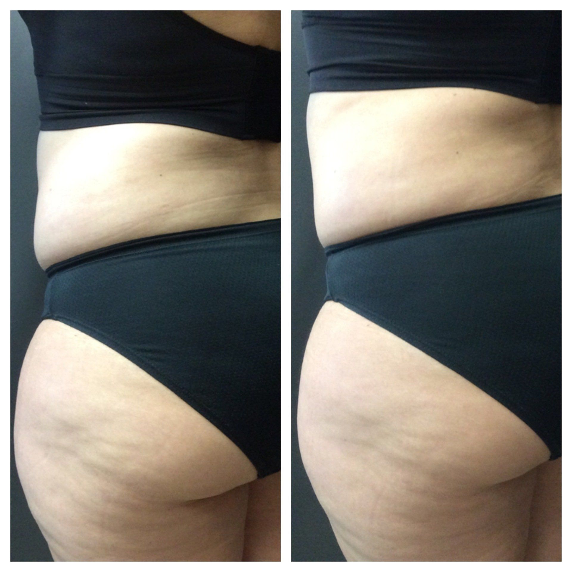 Before and After at Conway Med Spa