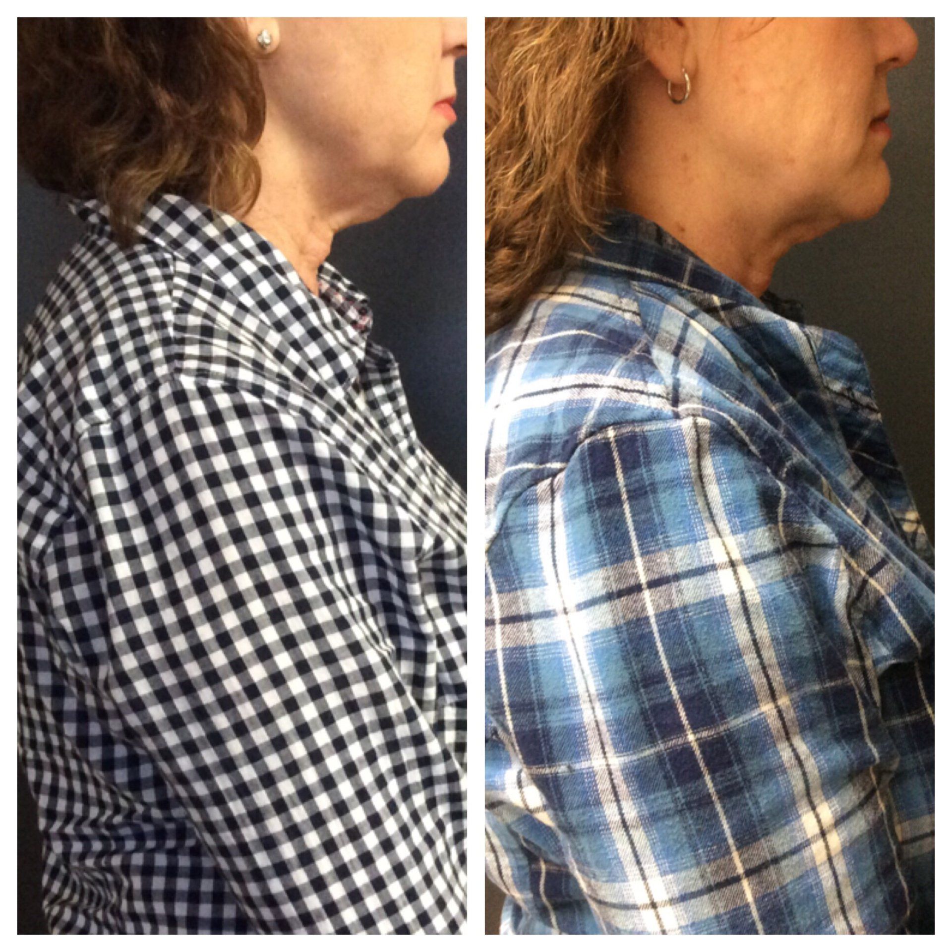 kybella, injectables